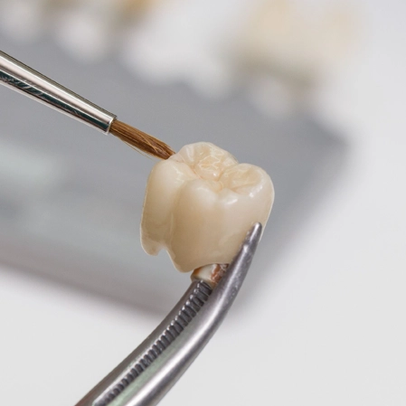 A dental crown being painted to match a patient's natural tooth color