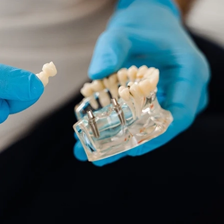 A dental technician wearing gloves and holding a mouth model with spots for implants