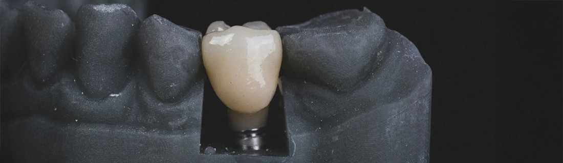 FC – Expert Dental Implants Services at Bella Family Dental, Dallas, TX FC – Expert Dental Implants Services at Bella Family Dental, Dallas, TX